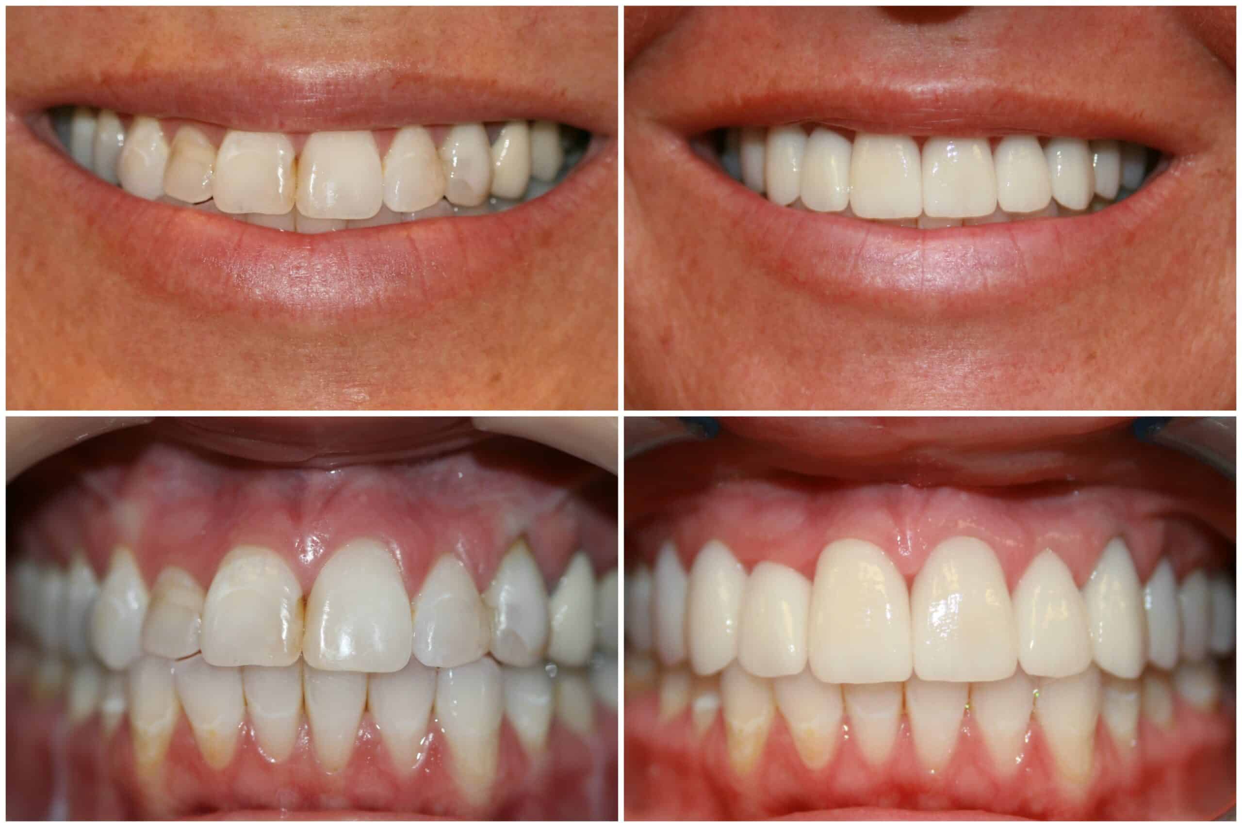 Peavie Capping Teeth Before And After