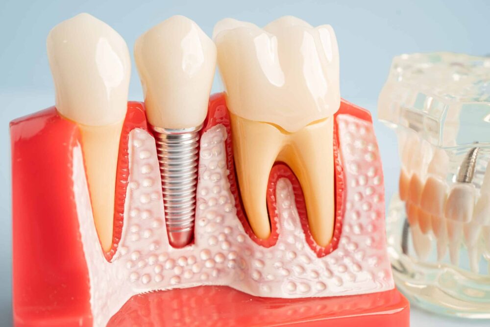 dental implants ammon ID