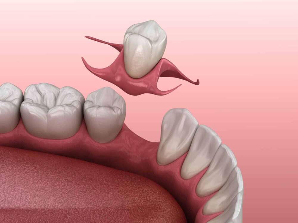 tooth replacement ammon