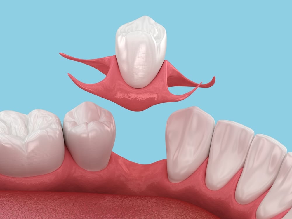 replacement of missing teeth